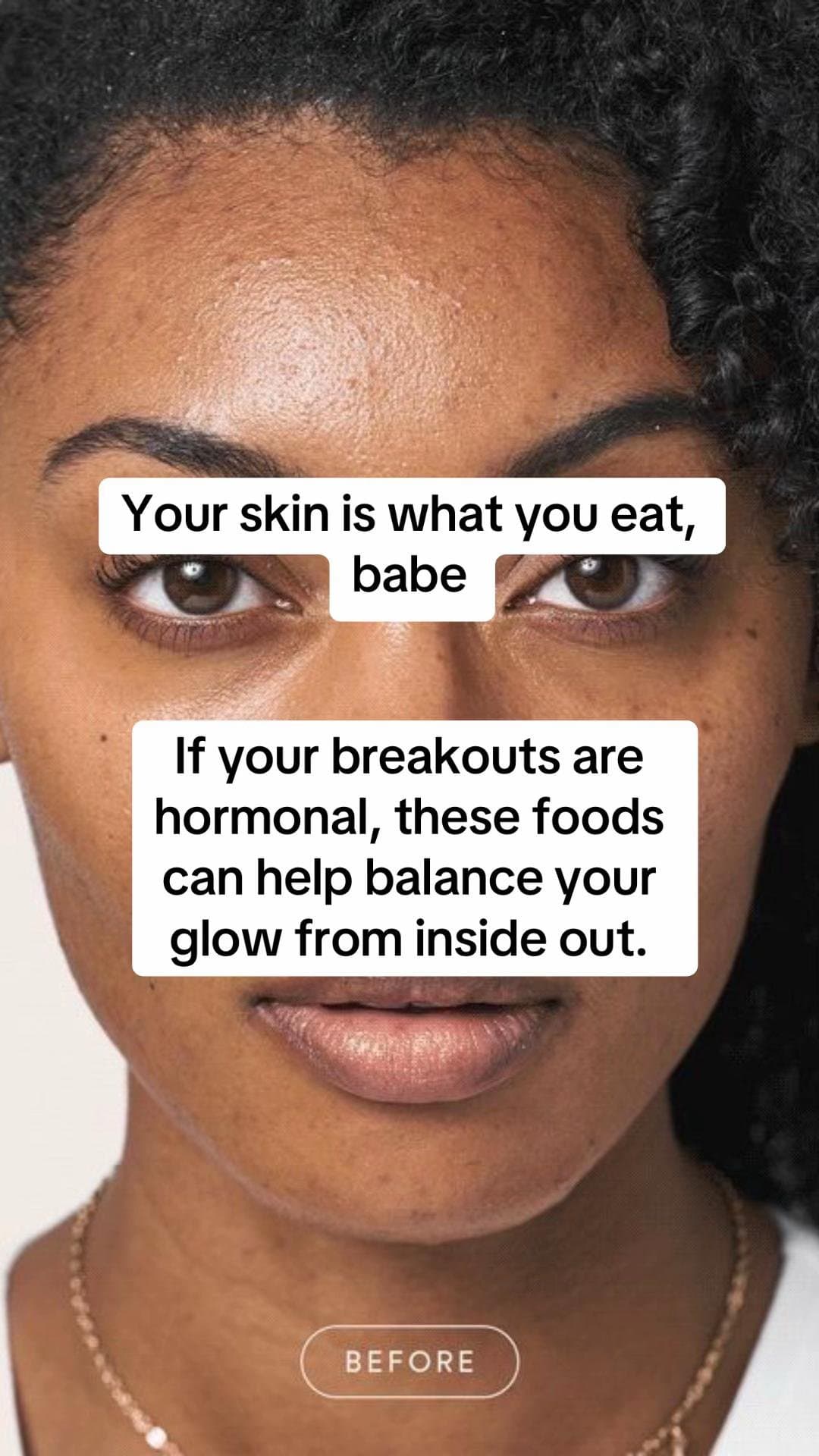 Slide 1: Your skin is what you eat,
babe

If your breakouts are
hormonal, these foods
can help balance your
glow from inside out.