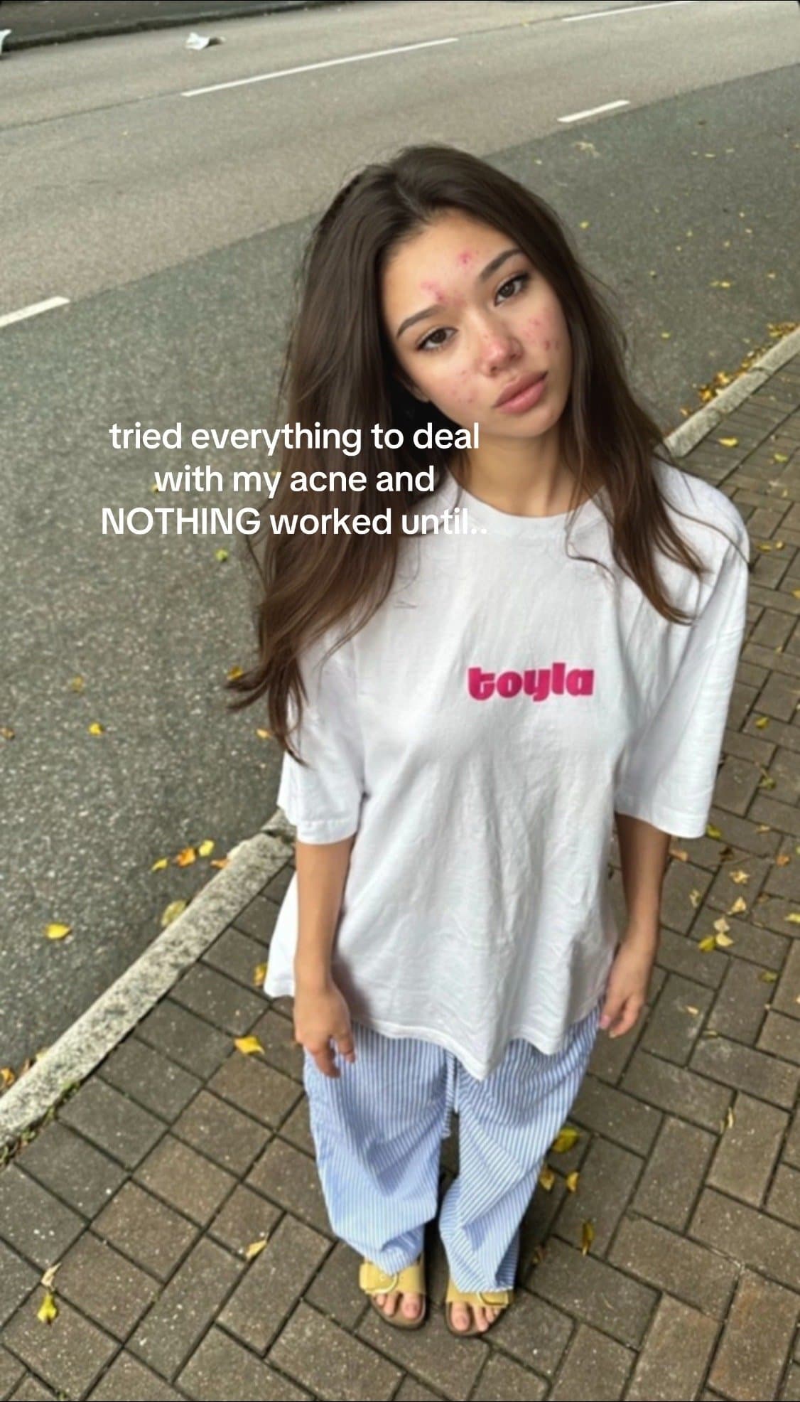 Slide 1: tried everything to deal
with my acne and
NOTHING worked until...